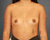 Feel Beautiful - Breast Augmentation 162 - Before Photo
